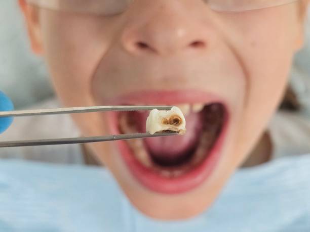 Best Emergency Treatment for Dental Infections or Abscesses in Hunters Creek Village, TX